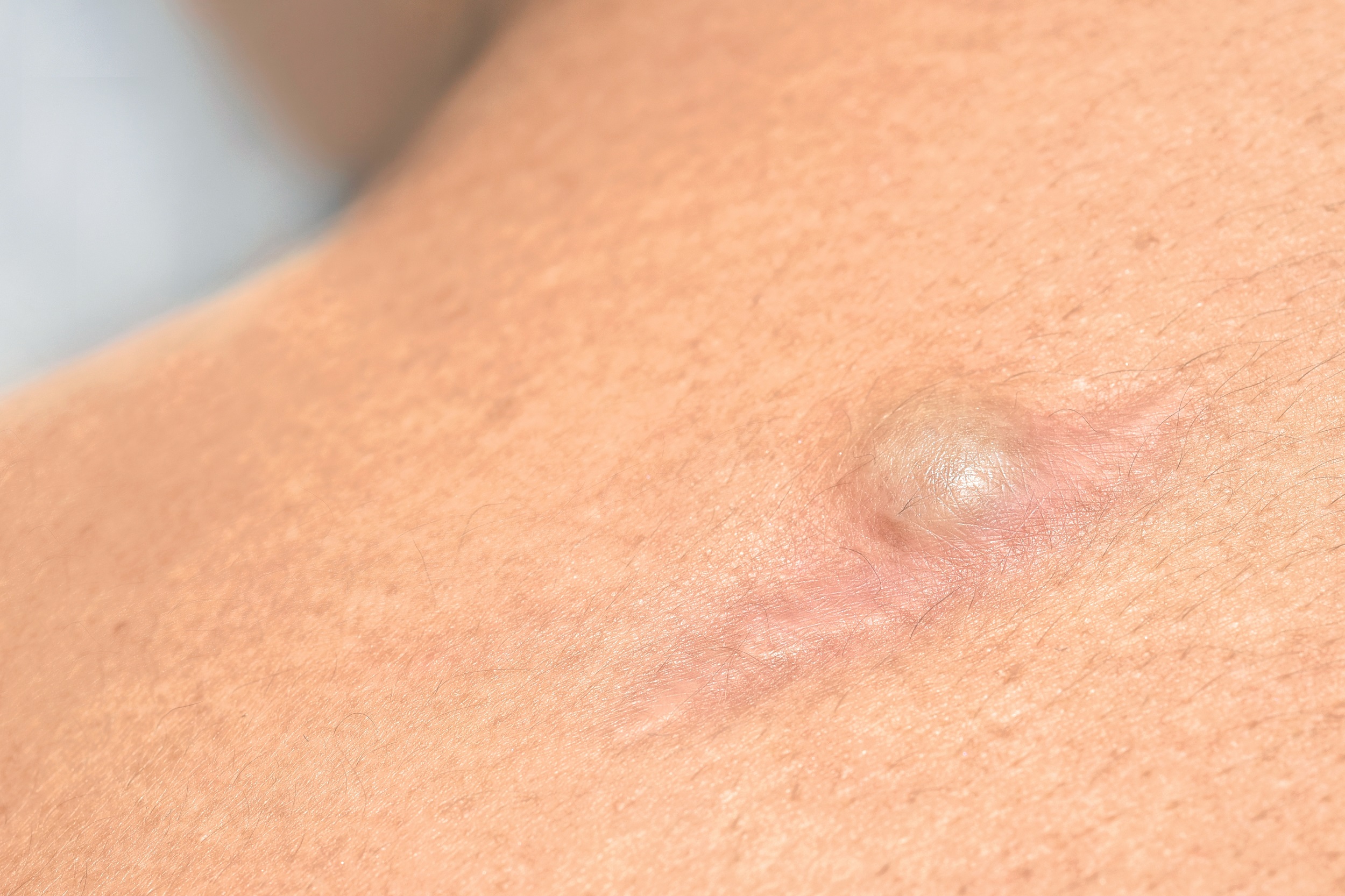 Recurring,Sebaceous,Cyst,(epidermoid,Cysts),At,The,Surgical,Wound,On