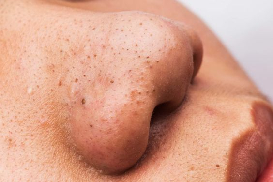 Wie entstehen schwarze Köpfe und was enthalten sie wirklich? Eine detaillierte Erklärung der Ursachen und der Zusammensetzung