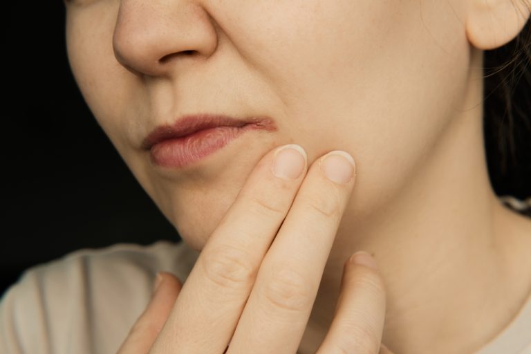 Lip,Herpes,And,Angular,Cheilitis,On,Womans,Face.,Beauty,Skin