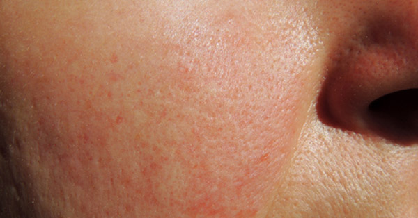 rosacea-og