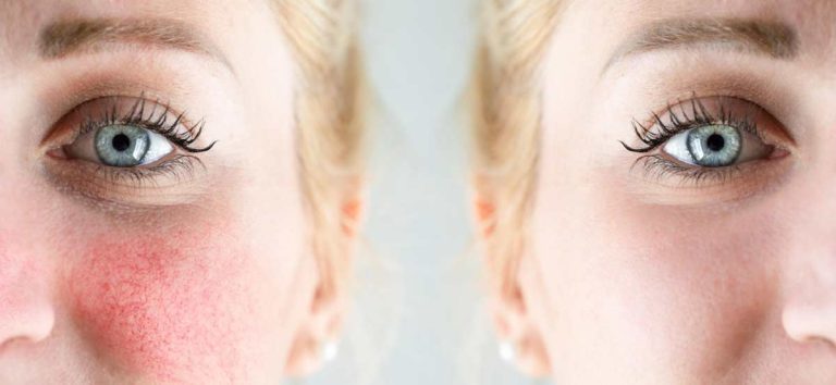 rosacea2-opt-1