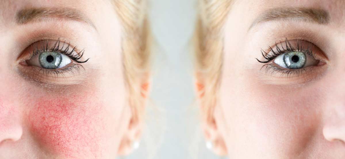 rosacea2-opt-1
