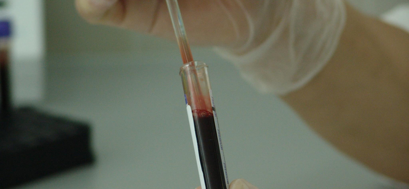 Megfizethető vérvizsgálat jelezheti előre a szívinfarktus és a stroke kockázatát