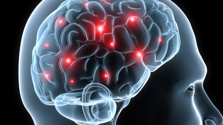brain_electrical_oscillation_signature_profiling_beos_105820_1_original_760x425_cover